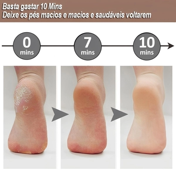 Soft Feet - Removedor de Calos e Rachaduras dos Pés